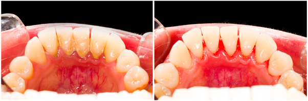 outils dentiste detartrage outils dentiste detartrage